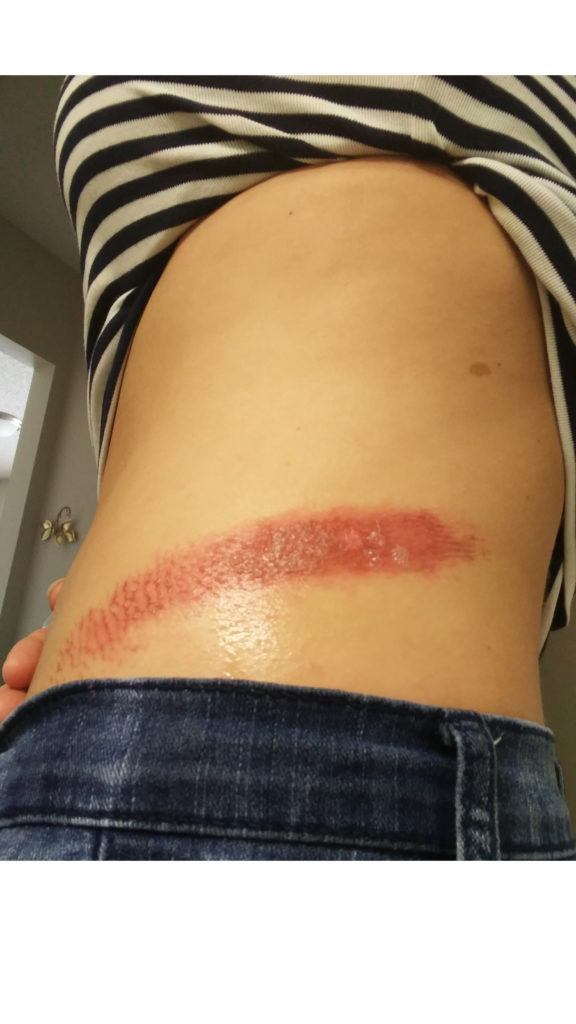 Rope burn! It's going to happen when you're an aerialist. Here's how I dealt with my worst one to date.